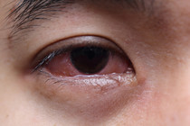 Why do we get bloodshot eyes, and how can we prevent it?